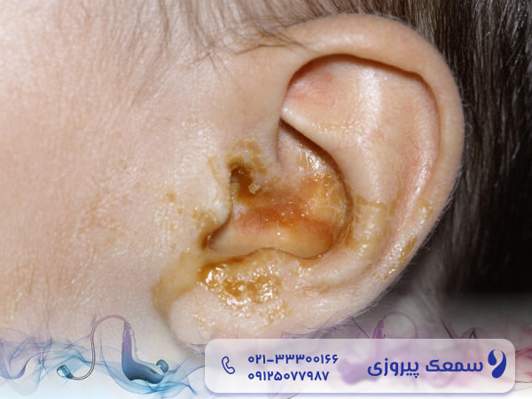 عفونت گوش کودکان